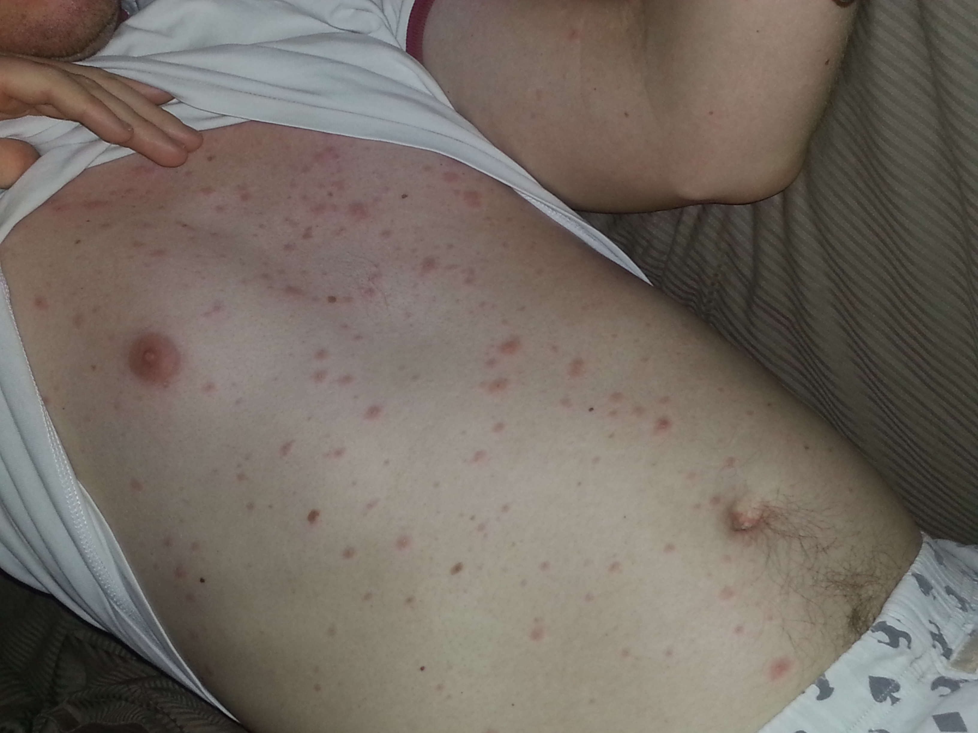 Chickenpox (Varicella) Photos - Vaccine Information You ...