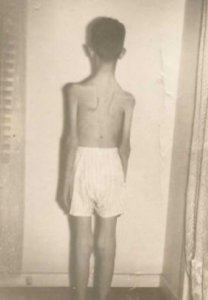 Jerry back view post polio.