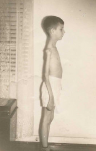 Jerry lost 50% of his body weight post polio. Here he is at 45 pounds, down from 90 pounds before he entered the hospital. 