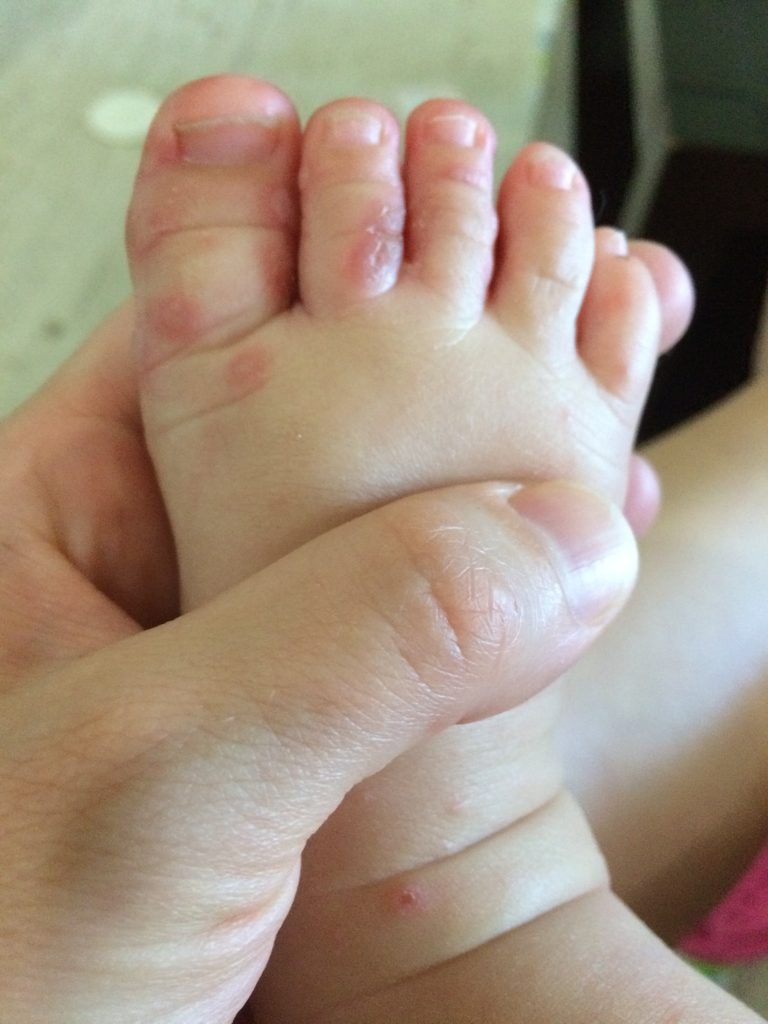 Hand, Foot, and Mouth If you have kids, this is a must read! The