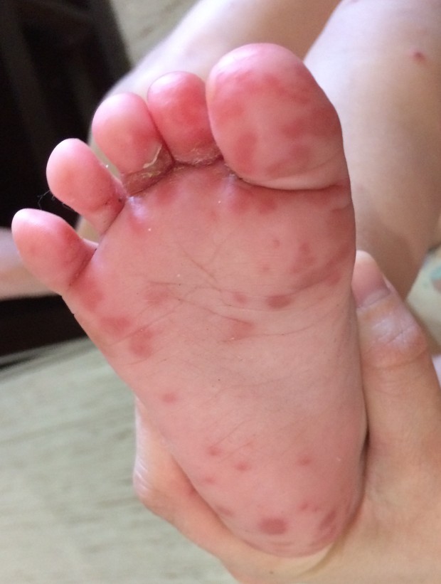 Hand, Foot, and Mouth If you have kids, this is a must read!