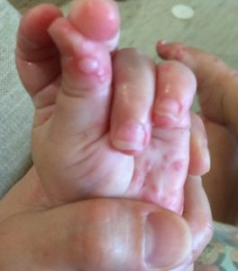 Stevie's hand