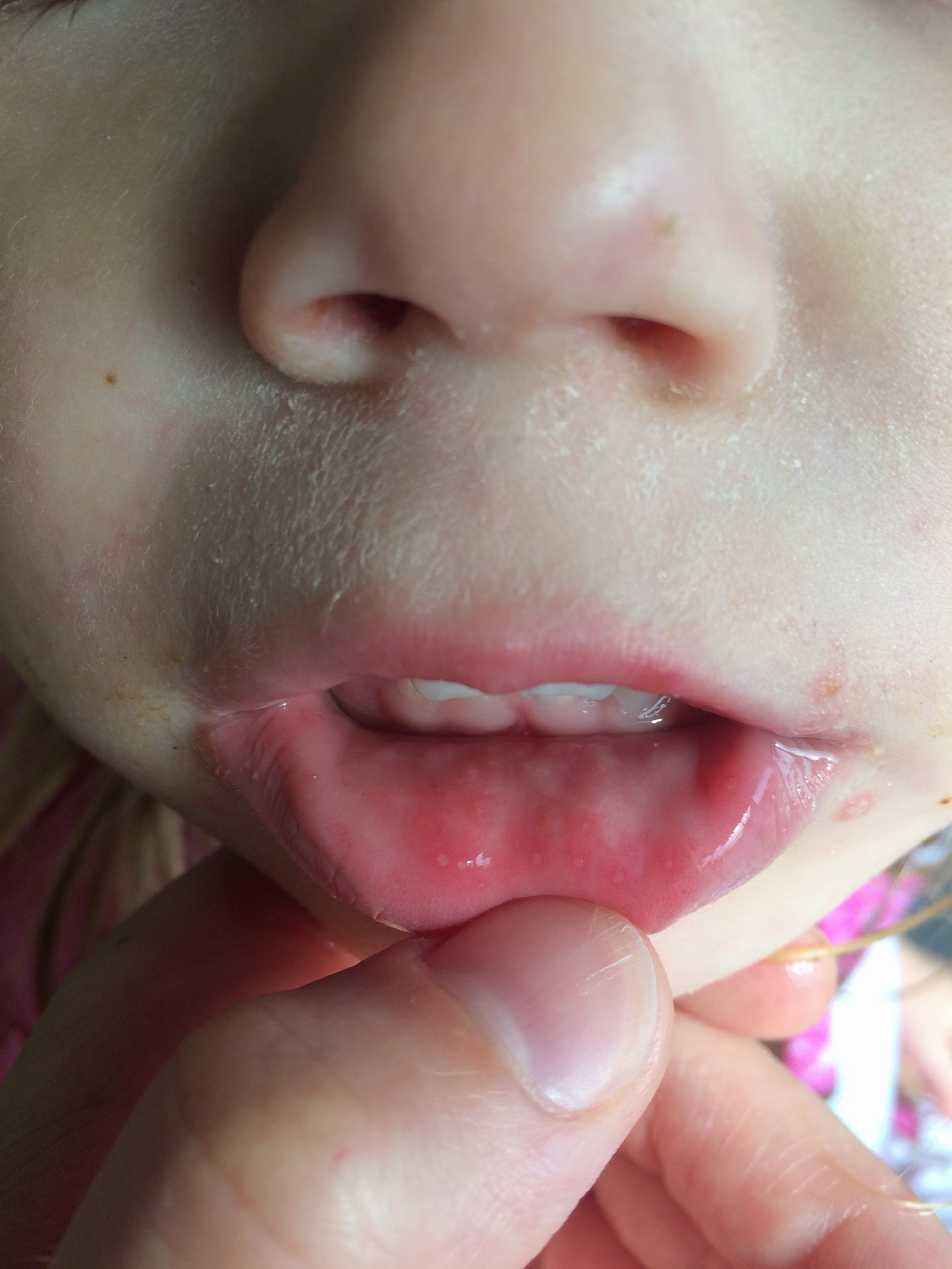 Hand, Foot, and Mouth If you have kids, this is a must read!