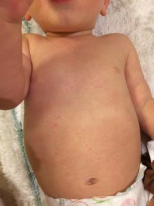 MMR Vaccine Rash