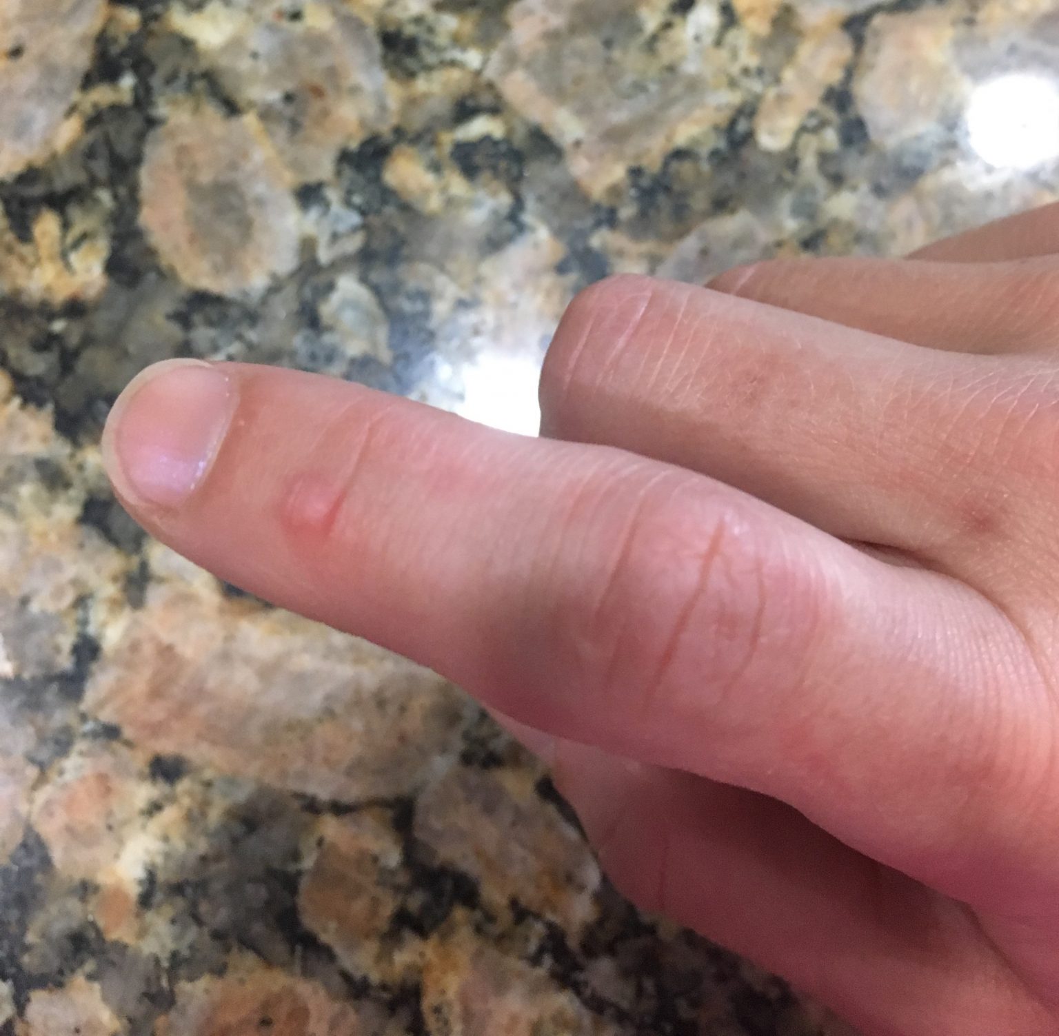 I have herpes viruses and so do YOU The Vaccine Mom