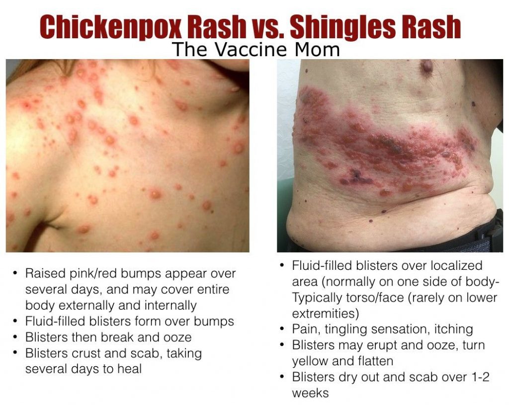 can dogs get chicken pox or shingles from humans